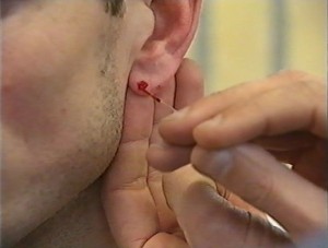 taking blood from the earlobe